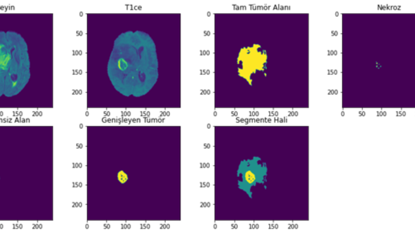 Brain Tumor Segmentation Project Image